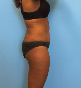 Abdominoplasty-Case--28134 | After Tummy Tuck 2