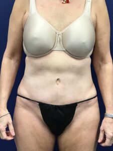 Abdominoplasty-Case--7963 | After Tummy Tuck 1