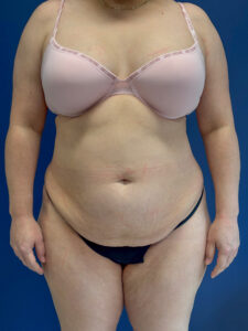 Abdominoplasty-Case--1259 | Before Dr. Frank Albino 1