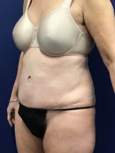 Abdominoplasty-Case--7963 | After Tummy Tuck 2