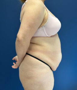 Abdominoplasty-Case--1259 | Before Dr. Frank Albino 2