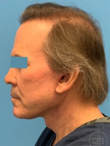 Men-Neck-Face-Lift-Case--23753 | After Face 1