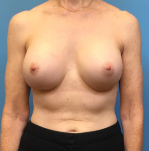 Revision-Augmentation-Case--236 | After Revision Augmentation 1