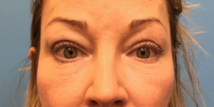 Upper-Blepharoplasty-Case--393 | After Eyelid Surgery 1