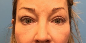 Upper-Blepharoplasty-Case--393 | After Face 1