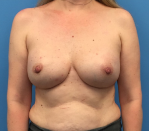 Breast-Reconstruction-Case--295 | After Dr. Samir Rao 1