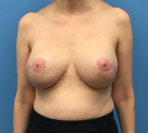 Breast-Reconstruction-Case--296 | After Dr. Samir Rao 1