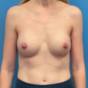 Breast-Reconstruction-Case--298 | After Dr. Samir Rao 1