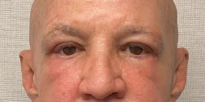 Blepharoplasty-Case--24169 | After Face 1