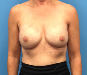 Breast-Reconstruction-Case--310 | After Dr. Samir Rao 1