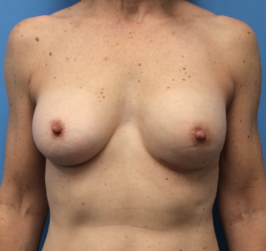 Breast-Reconstruction-Case--312 | After Dr. Samir Rao 1