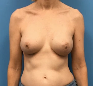 Breast-Reconstruction-Case--313 | After Breast Reconstruction 1