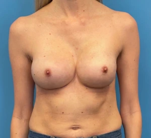 Case--317 | After Breast Reconstruction 1