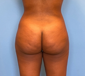 Brazilian-Butt-Lift-Case--263 | After Brazilian Butt Lift 1