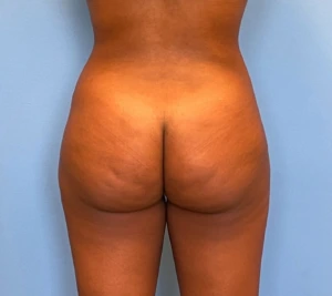 Brazilian-Butt-Lift-Case--263 | After Body 1