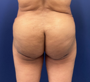 Brazilian-Butt-Lift-Case--215 | After Brazilian Butt Lift 1