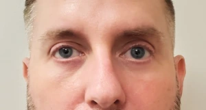 Lower-Blepharoplasty-Case--359 | After Face 2