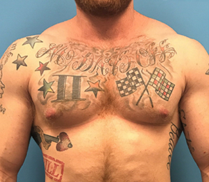 Gynecomastia-Case--143 | After Gynecomastia / Male Breast Reduction 1