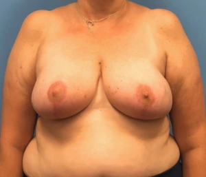 Breast-Reduction-Case--13597 | After Breast Reduction 1