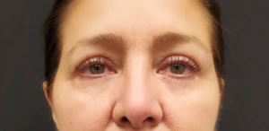 Quad-Blepharoplasty-Case--358 | After Face 2