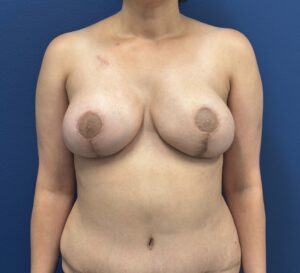 DIEP-Flap-Case--27227 | After DIEP Flap 1