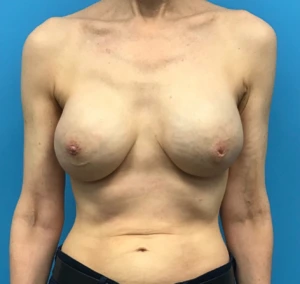 Case--302 | After Breast Reconstruction 1