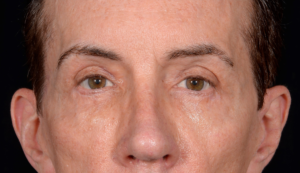 Quad-Blepharoplasty-Case--357 | After Eyelid Surgery 2