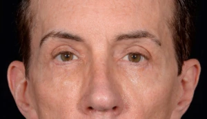 Quad-Blepharoplasty-Case--357 | After Face 2