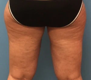 Case--278 | After Liposuction 2