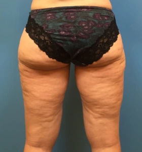 Case--281 | After Body 2