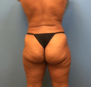 Case--247 | After Body 2