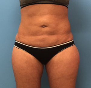 Liposuction-Case--72-1 | After Liposuction 1