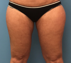 Case--278 | After Liposuction 1