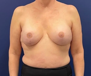 Breast-Reconstruction-Case--308 | After Dr. Samir Rao 1