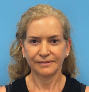 Facelift-Case--292 | After Face 1