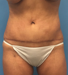 Case--65 | After Liposuction 1
