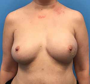 Case--136 | After Dr. Samir Rao 1