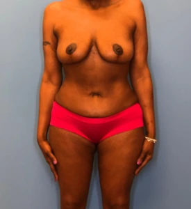 Mommy-Makeover-Case--13869 | After Body 1