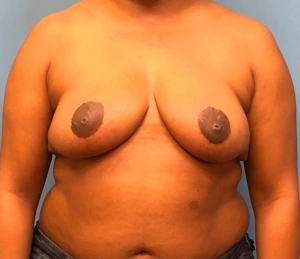 Breast-Reduction-Case--12894 | After Breast Reduction 1