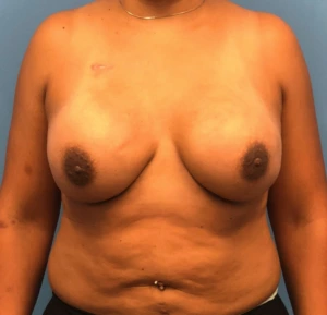 Case--11132 | After Breast Reconstruction 1