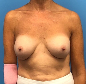 Revision-Augmentation--13287 | After Dr. Samir Rao 1