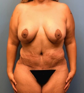 Lipoabdominoplasty-Breast-Augmentation-Case--15133 | After Body 1
