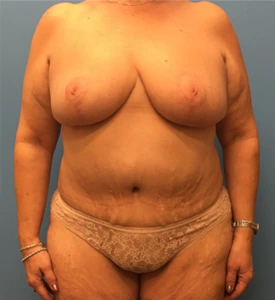 Mommy-Makeover-Case--39 | After Body 1