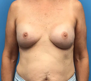 Case--133 | After Breast Reconstruction 1