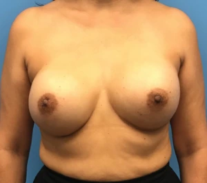 Case--134 | After Breast Reconstruction 1