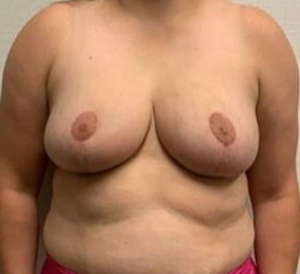 Breast-Reconstruction-Case--26525 | After Dr. Frank Albino 1
