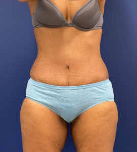 Abdominoplasty-Case--24922 | After Liposuction 1