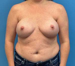 Breast-Reconstruction-Case--27065 | After Dr. Samir Rao 1