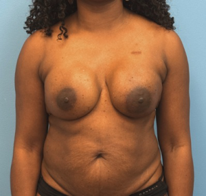 Breast-Reconstruction-Case--23930 | After Dr. Samir Rao 1