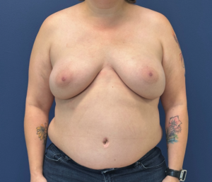 DIEP-Flap-Case--28021 | After DIEP Flap 1